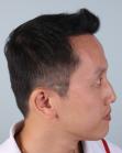 After Hair Transplant&nbsp;Front